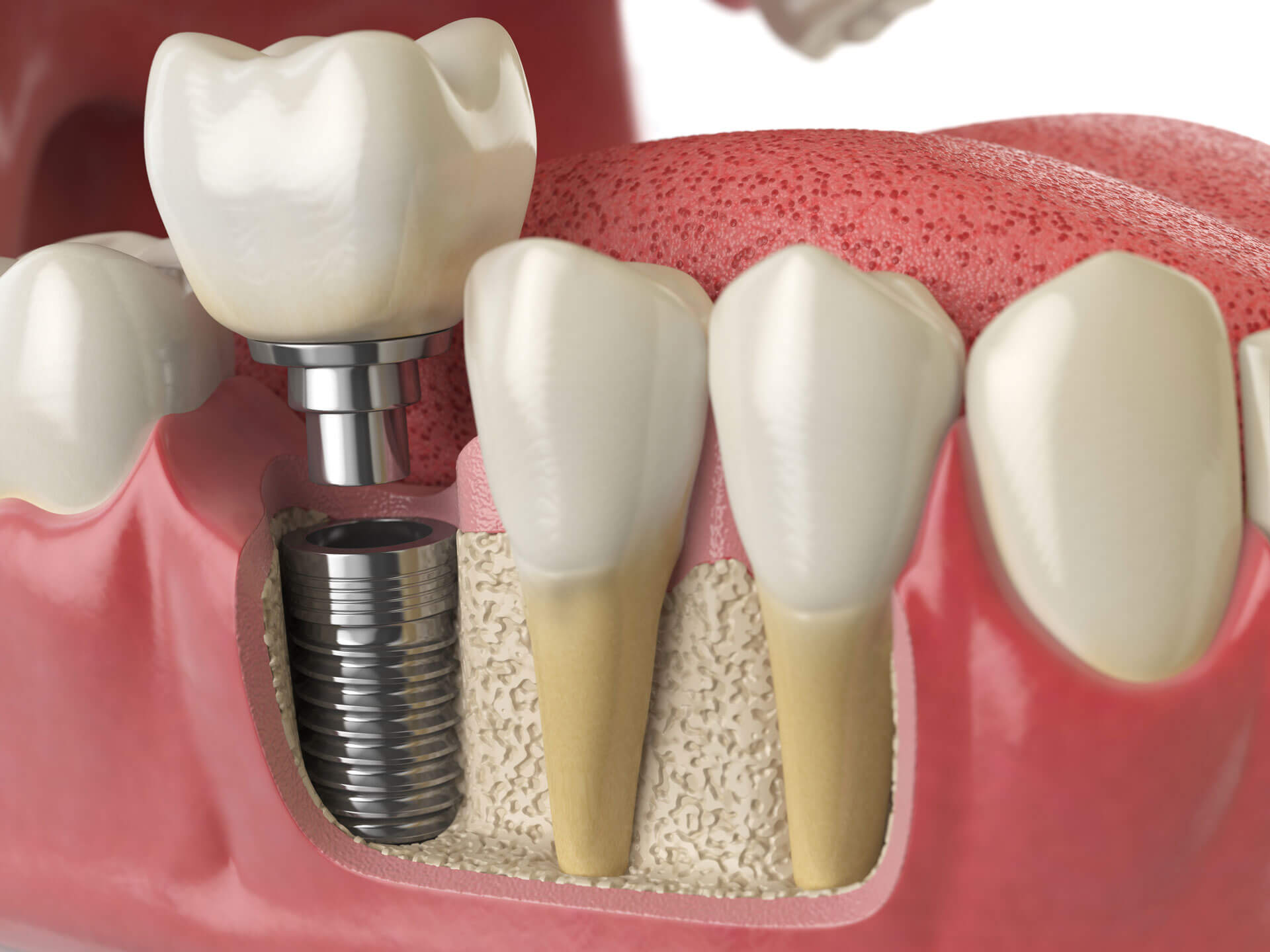 Implant dentaire : comment peut-on s'y adapter ?